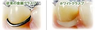 ホワイトクラスプ